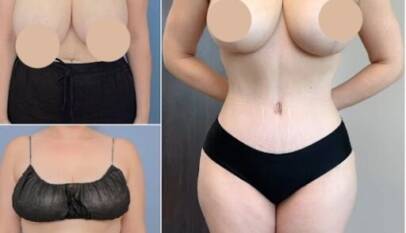 Tummy Tuck in Dubai