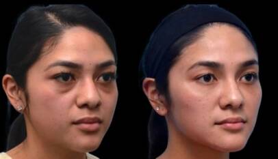 Dark Circles Treatment in Dubai
