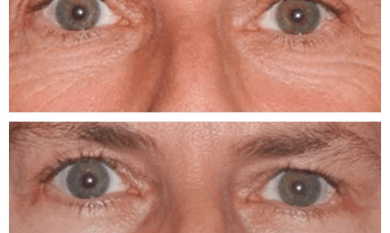 Eye Bag Removal in Dubai
