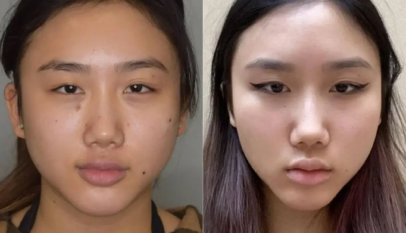 Buccal Fat Removal in Dubai