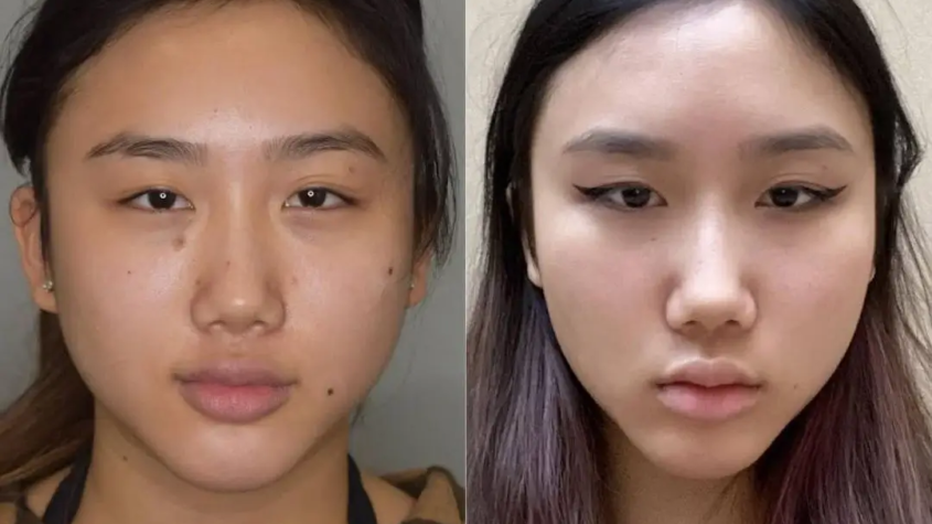 Buccal Fat Removal in Dubai