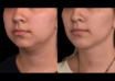 Double chin removal in Dubai