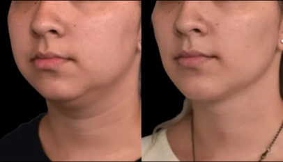 Double chin removal in Dubai