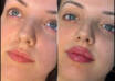 Dermal Fillers in Dubai