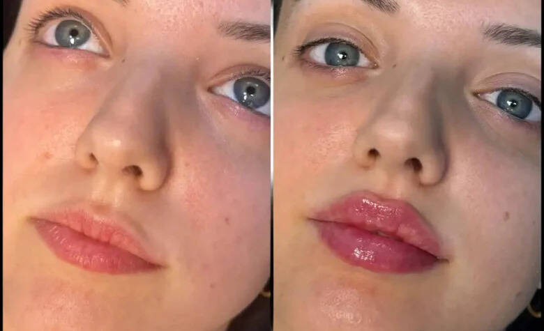 Dermal Fillers in Dubai