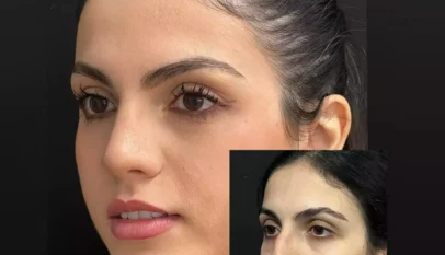 Septoplasty in Dubai