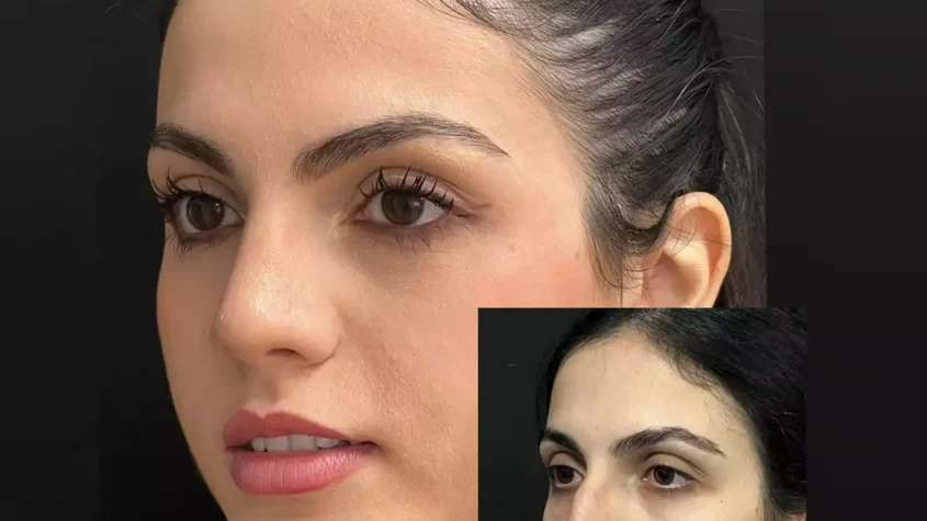 Septoplasty in Dubai