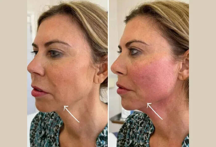 Why Busy Professionals Prefer Endolift Treatments in Dubai