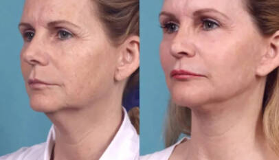 Chemical Peel Treatment in dubai