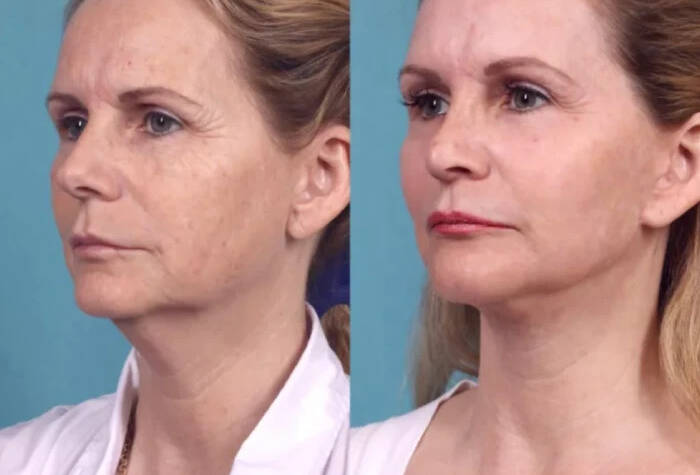 Chemical Peel Treatment in dubai