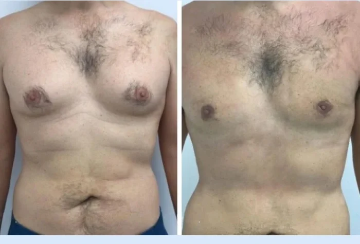 Gynecomastia in Dubai