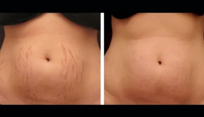 Radiofrequency (RF) Microneedling in dubai