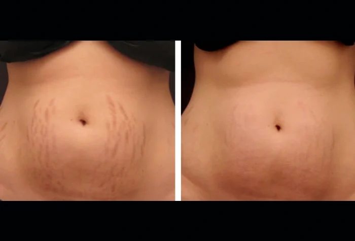 Radiofrequency (RF) Microneedling in dubai