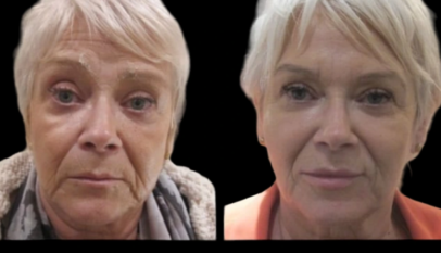 Jawline Fillers in Dubai