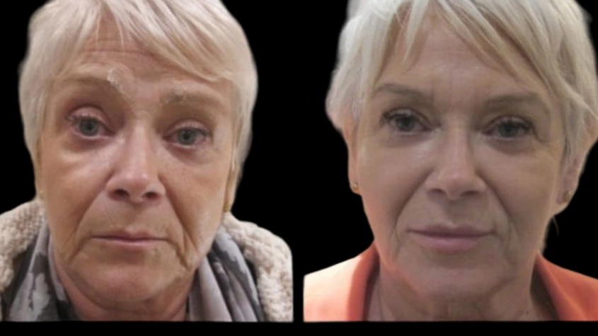 Jawline Fillers in Dubai