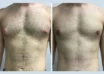 Gynecomastia in Dubai