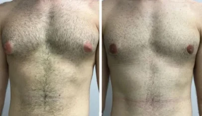 Gynecomastia in Dubai