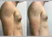 gynecomastia in dubai