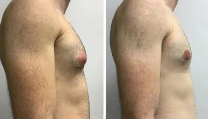 gynecomastia in dubai