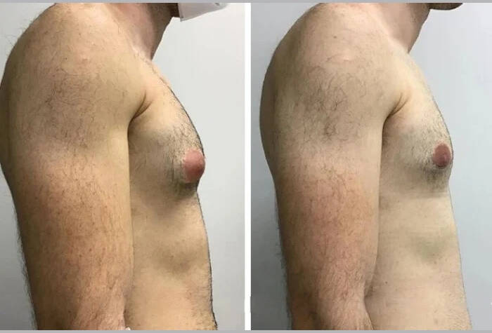 gynecomastia in dubai
