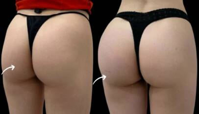 sculptra fillers in dubai