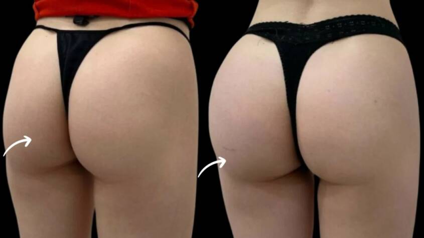 sculptra fillers in dubai