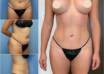 Body Contouring in Dubai