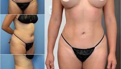 Body Contouring in Dubai
