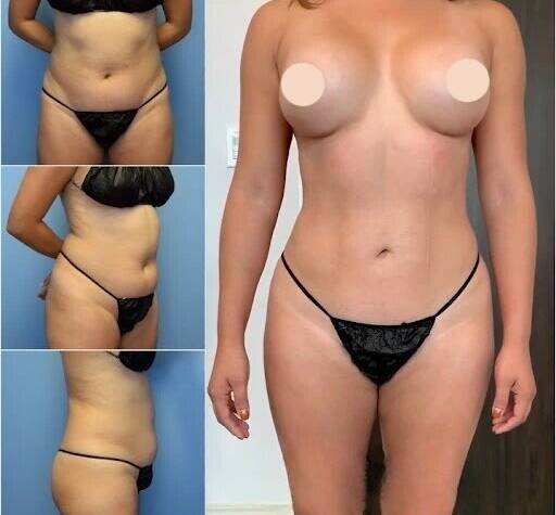 Body Contouring in Dubai