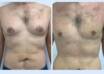 gynecomastia in dubai