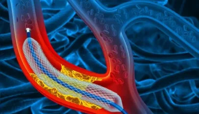 Best Angioplasty Cost in Dubai with World-Class Cardiac Care