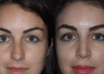 rhinoplasty in dubai