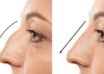rhinoplasty in lahore
