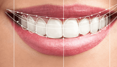 Digital Smile Design Dubai