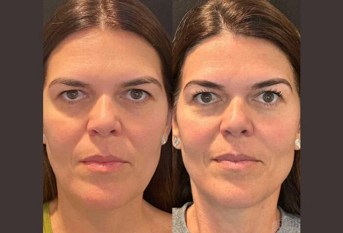 Thread Lift in Dubai