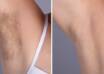 Electrolysis Laser hair removal in dubai