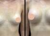 breast enlargement in Dubai