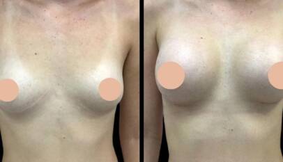 breast enlargement in Dubai