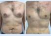 Gynecomastia in Dubai
